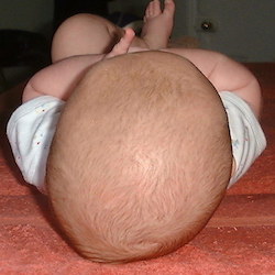 About Plagiocephaly